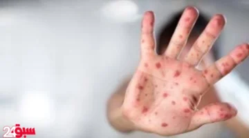 فيروس المدارس يغلق الحضانات.. علامات إصابة مبكرة بطفلك عليكِ معرفتها فورا